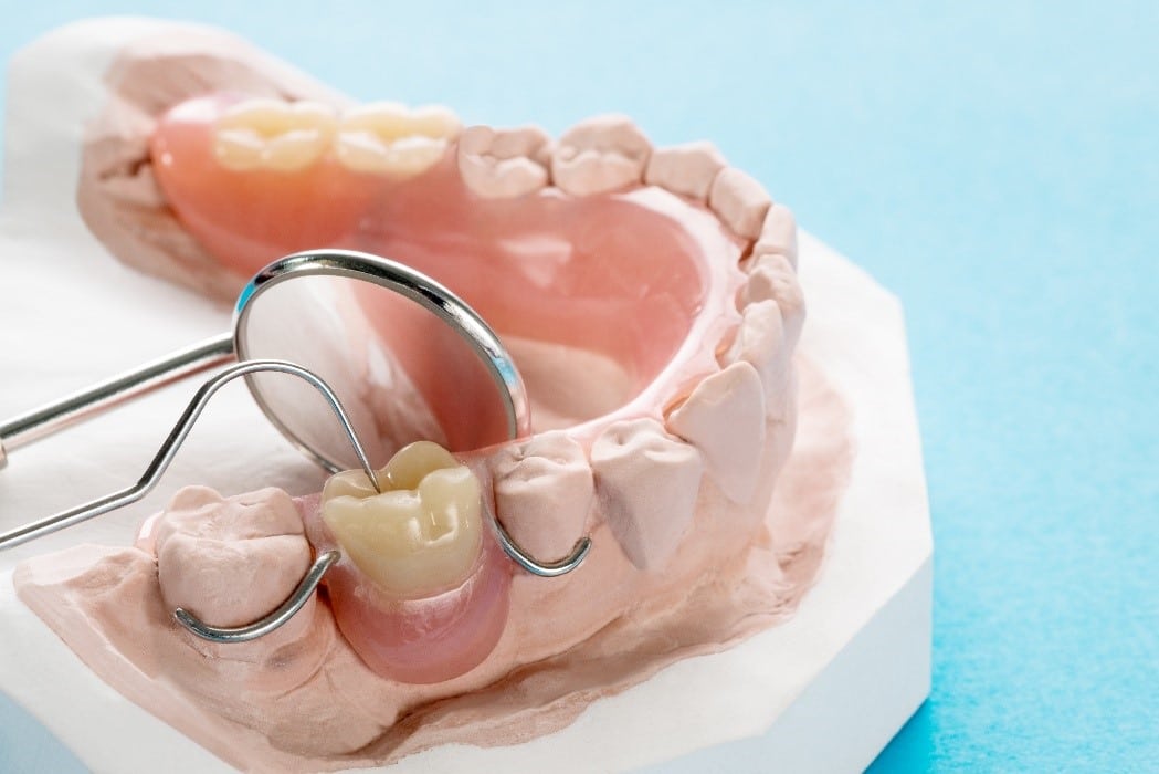 Choosing Between Removable Partial Dentures Or Single Dental Implants 